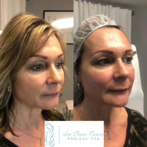 Thread lift procedure before and after for a younger looking appearance