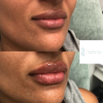 Lip Injections Before & After
